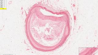 Atheroma and Thrombus Micro [upl. by Mcwilliams]