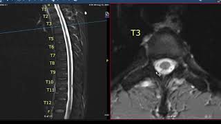 Multiple Sclerosis Vlog Thoracic Spine MRI [upl. by Lose673]