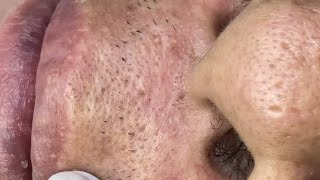 blackheads between mouth and nose  dermacool 0116 [upl. by Hceicjow156]