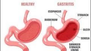 شرح Gastritis بالتفصيل 💫🔥💯 [upl. by Ydnahs]