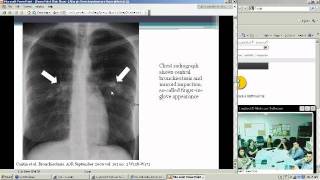 Allergic Bronchopulmonary Aspergillosis Heather Doss MD [upl. by Luke]