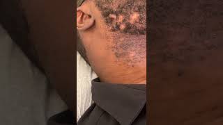 Keloid of Face  Treatment with cryotherapy [upl. by Glass224]