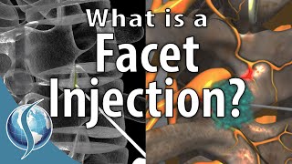 What is a Facet Injection [upl. by Lejeune]