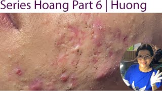 Acne Treatment Huong Da Nang 023  Series 6 Hoang Loyal fans [upl. by Lenwood]