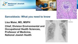 Diagnosis to Management What You Need to Know about Living with Sarcoidosis [upl. by Athalia]