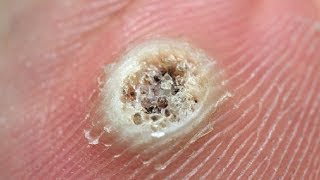 5 Remedies  How To Get Rid Of Verruca  Remove Warts [upl. by Wivinia]