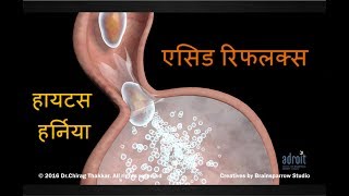 एसिड रिफ्लक्स एसिडिटी Hiatus Hernia और GERD की संपूर्ण जानकारी Acid Reflux Acidity heartburn [upl. by Cadmann]