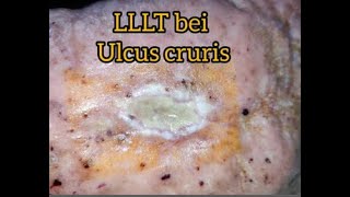 Ulcus Cruris Behandlung mit LLLT  HELBO Minilaser 3120 Anleitung Ulcus mit Laser behandeln [upl. by Aimerej392]