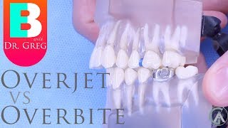 BRACES EXPLAINED Overbite vs Overjet [upl. by Aicined]