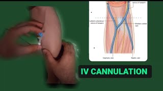 IV CANNELTON 😍  NURSESCOPE [upl. by Nycila]