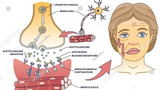 Myasthenia Gravis  the effects [upl. by Pineda]