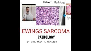 Bone tumor Pathology Ewing Sarcoma [upl. by Gnouhp574]