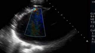 Giant left atrium due to rheumatic mitral stenosis and regurgitation [upl. by Elazaro]