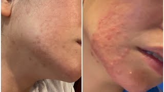 Lymecycline for Acne 3 Months Antibiotics  Weekly Vlogs [upl. by Enelcaj936]