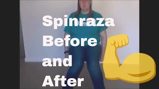 Spinraza Before and After [upl. by Mcgrath]