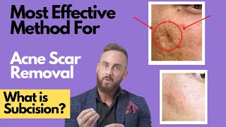 How To Treat DEEP ACNE SCARS  What is SUBCISION [upl. by Anujra827]