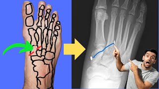 Lisfranc Injury Can it be fixed with an ANKLE TIGHTROPE [upl. by Okire]