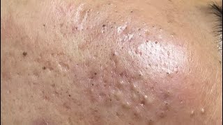 ACNE TREATMENT VU QUYNH MI Acne On Boys Cheek 2024 [upl. by Huckaby529]