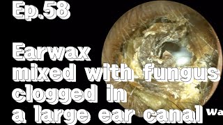 ep58 Severe earwax removal [upl. by Roots]