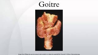 Goitre [upl. by Amal]