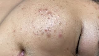 ACNE TREATMENT VU QUYNH MI  Perennial Blackheads On Boy Face 2024FULL [upl. by Aileahcim618]