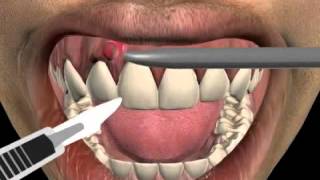 How to treat a tooth abscess [upl. by Liagabba]