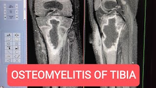 MRI of Tibia with Contrast  Diagnosing Osteomyelitis on GE 15 Tesla [upl. by Htiekal]