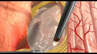 Animation  Spinal Cord Intramedullary Tumormov [upl. by Charlot]