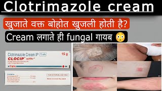 Clotrimazole cream review usesideeffectantifungal cream [upl. by Jeffery]