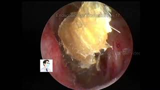 Ear wax removal CERUMEN Cleaning 20220117 [upl. by Mallina515]