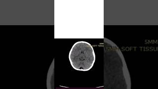 A CSF density lesionarea along in the region of cisterna magnaArachnoid cyst Mega cisterna magna [upl. by Tine]