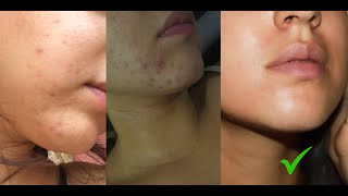 Curé mi ACNÉ HORMONAL EN 2 meses ✅ sin dermatologo 100 REAL 👍🏻 [upl. by Hairakcaz]