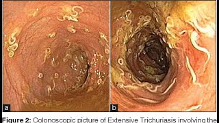 Trichuris Trichura  Trichuriasis  Morphology  Life Cycle Pathogenesis  Treatment  Microbiology [upl. by Lomax]