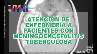 Atención de Enfermería a Pacientes con Meningoencefalitis Tuberculosa [upl. by Aicaca]