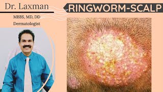 Tinea Capitis  Fungal Infection Of Scalp  Scalp Ringworm  Hair Fungus  Kerion  Black Dot [upl. by Akeret]