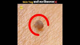 Skin Tag कभी मत निकालना ❌  Never Remove Skin Tag  The Fact  shorts ytshorts [upl. by Lilyan610]