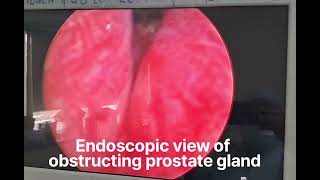 Transurethral Resection of Prostate TURP for Obstructing prostate gland [upl. by Sari]