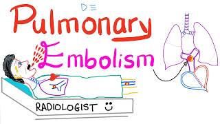 Pulmonary Embolism PE  Causes Symptoms Signs Diagnosis amp Treatment  Respiratory System [upl. by Papert]