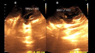 Bilateral hydro nephrosis  Bilateral dilated ureter  Renal Ultrasonography [upl. by Neala629]