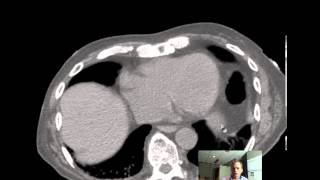 CT Abdomen and Pelvis ANATOMY Discussion by Radiologist [upl. by Dlonyer417]