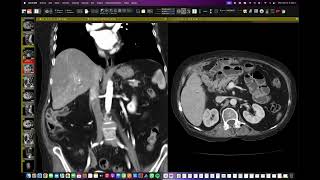 Colangitis por Estenosis de hepatoyeyuno anastamosis [upl. by Chico]