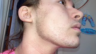 Every Single Picture of Minoxidil and Derma roller Beard Growth Week 1  16 [upl. by Aniraz]