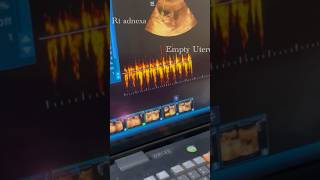 Unruptured Live Ectopic Pregnancy ectopicpregnancy ultrasonography [upl. by Roberson583]