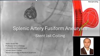 Splenic artery aneurysm stent jail coiling [upl. by Tehc980]