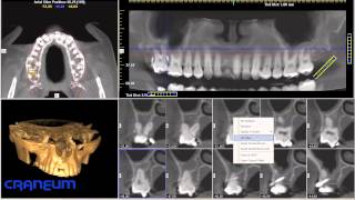 Tutorial CRANEUM iCat Vision  parte1  Tomografia Computadorizada Volumetrica  Cone Beam [upl. by Frodina]