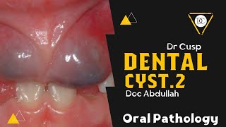 Dental Cyst quot Oral Pathology quot Second lecture  Zagazig University [upl. by Yenffad936]