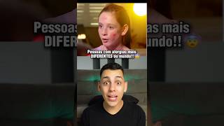 PESSOAS COM ALERGIAS MAIS DIFERENTES do MUNDO 😨😱 curiosidades edusouzzav [upl. by Auqinom]