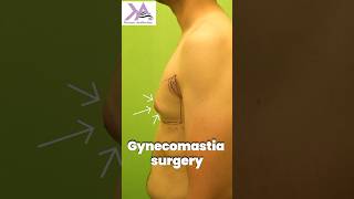 Smooth amp Seamless  Gynecomastia Surgery  Gyno Surgery Results painless plasticsurgery [upl. by Maidel]