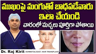 How to Get Rid of Melasma on Face  Melasma Solution in Telugu  Celestee Skin And Hair Clinic [upl. by Voss926]