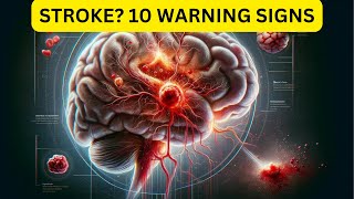 STROKE 10 WARNING SIGNS [upl. by Jevon589]